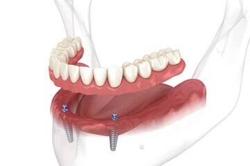 Implant Supported Overdenture