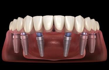 Implant supported Fix Prosthesis