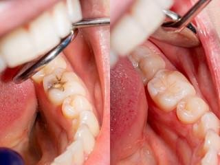 Painless Dental Cavity Fillings