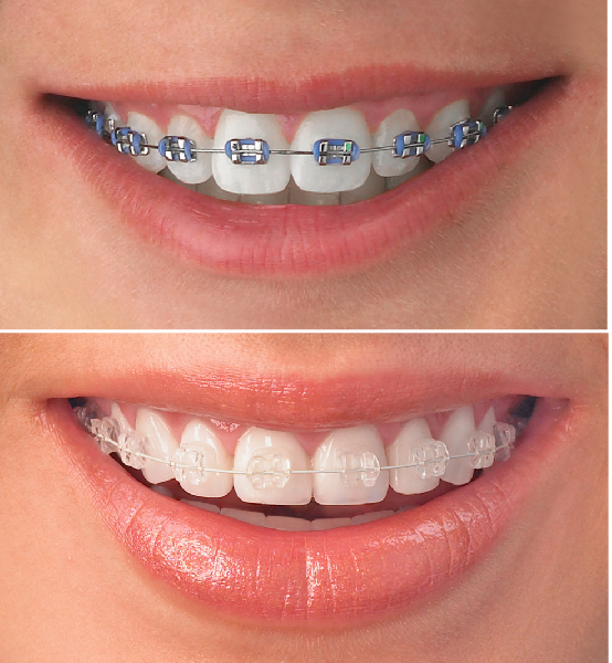  Orthodontic Treatment (Braces & Aligners)